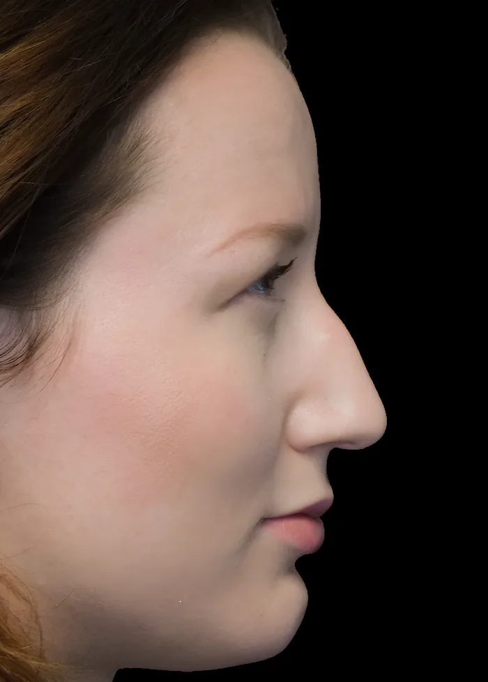 Rhinoplasty after, RHIN-007