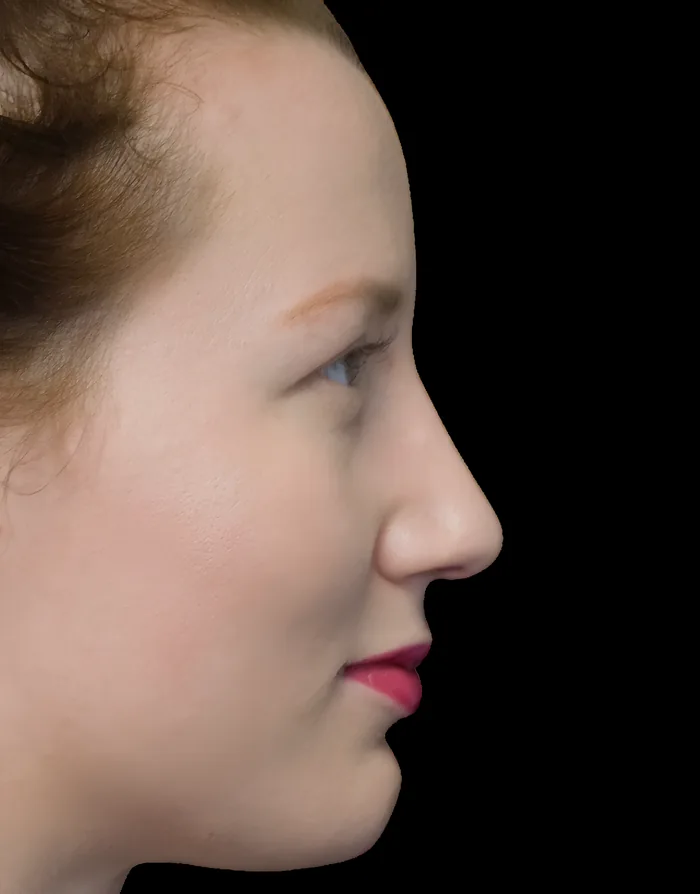 Rhinoplasty before, RHIN-007