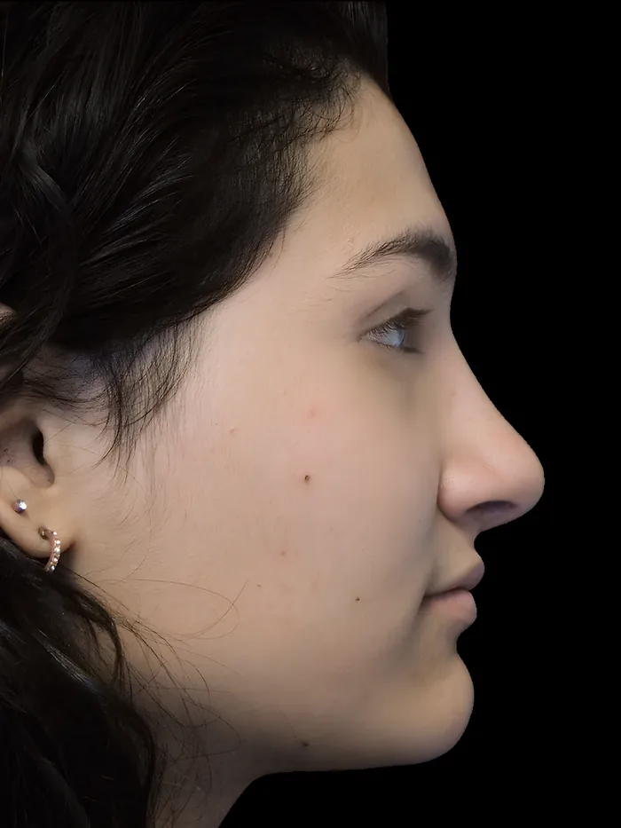 Rhinoplasty after, RHIN-008
