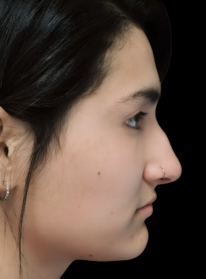 Rhinoplasty before, RHIN-008