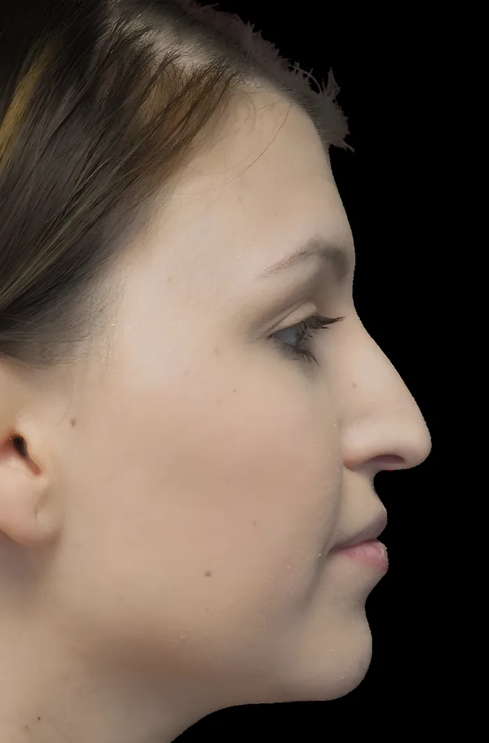 Rhinoplasty after, RHIN-009