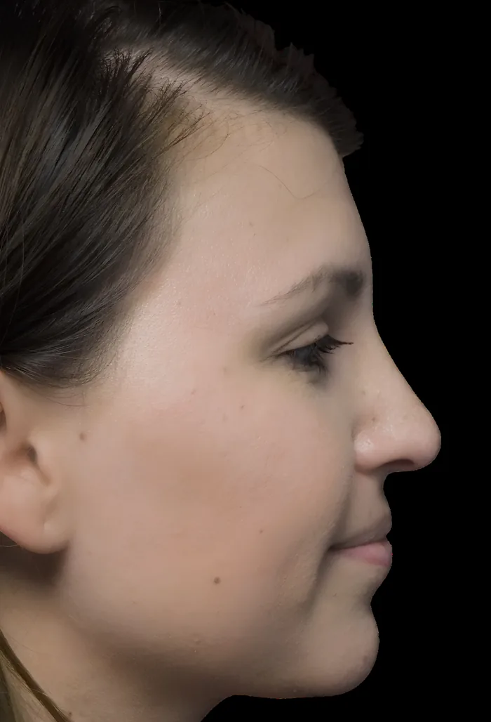 Rhinoplasty before, RHIN-009