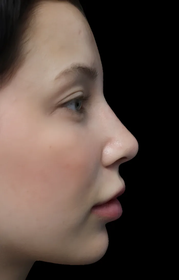 Rhinoplasty after, RHIN-010