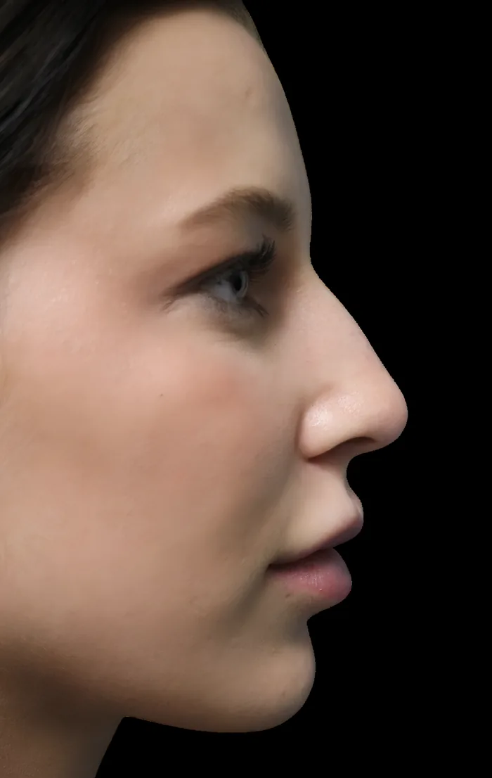 Rhinoplasty before, RHIN-010