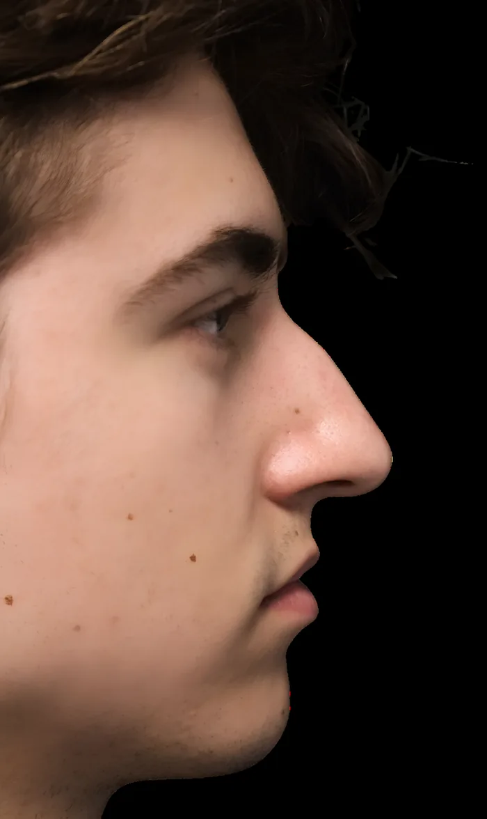 Rhinoplasty after, RHIN-011