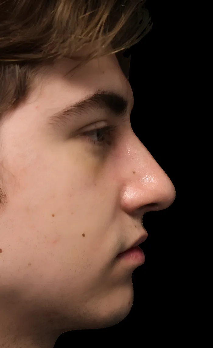 Rhinoplasty before, RHIN-011