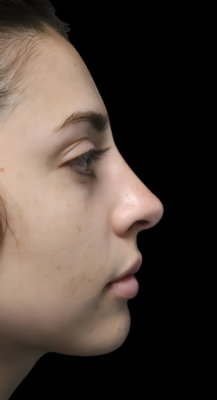 Rhinoplasty after, RHIN-012