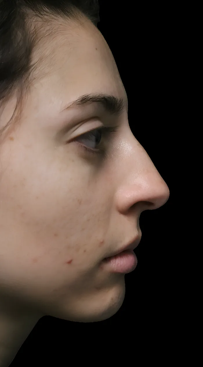 Rhinoplasty before, RHIN-012