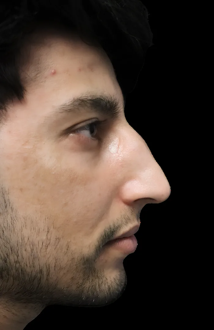 Rhinoplasty after, RHIN-013
