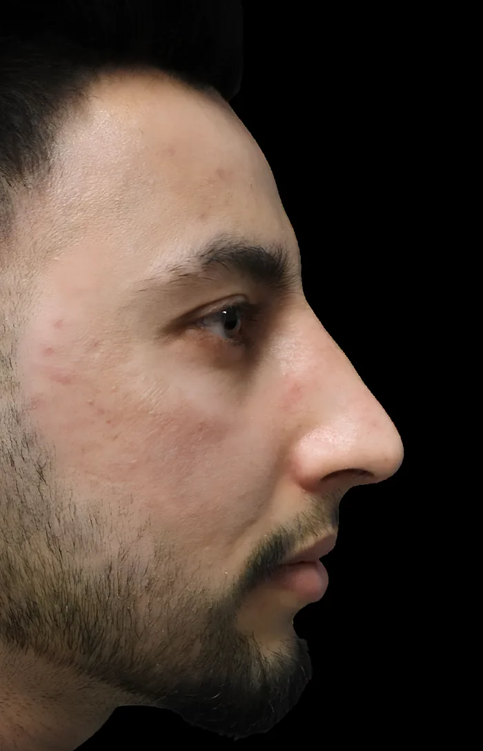 Rhinoplasty before, RHIN-013