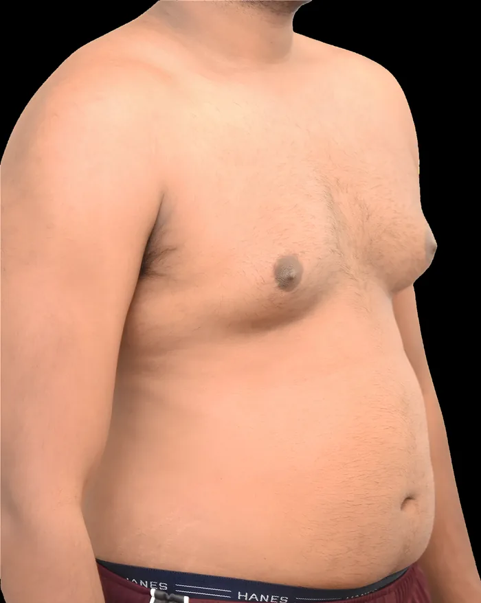 Gynaecomastia after, GYNO-001