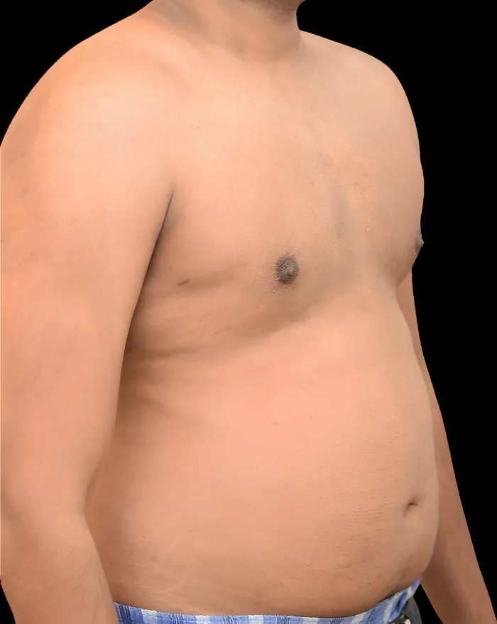 Gynaecomastia before, GYNO-001