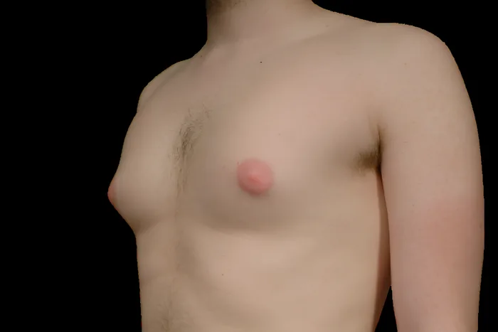 Gynaecomastia after, GYNO-002