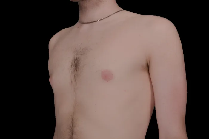 Gynaecomastia before, GYNO-002