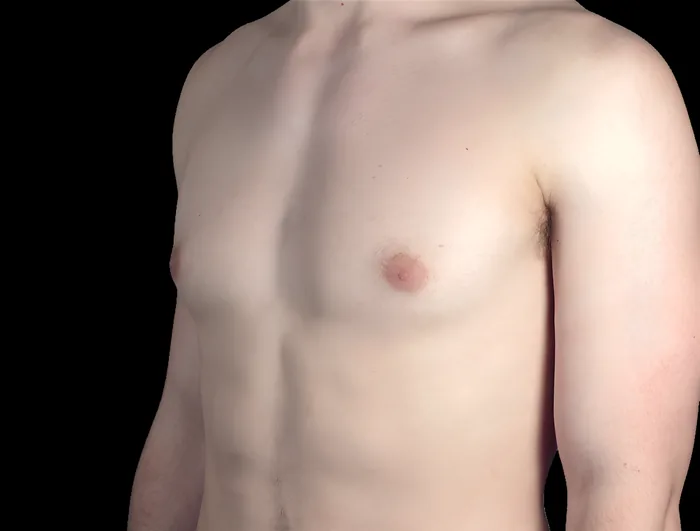 Gynaecomastia after, GYNO-003
