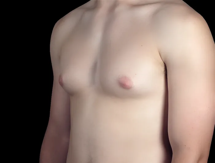Gynaecomastia before, GYNO-003