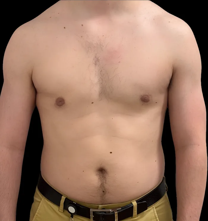 Gynaecomastia after, GYNO-004
