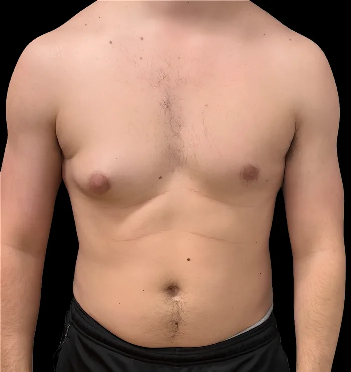 Gynaecomastia before, GYNO-004
