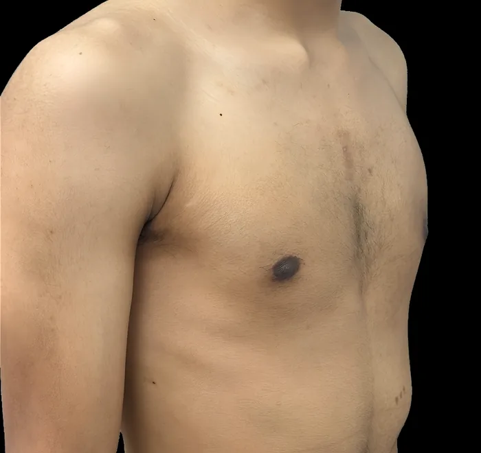Gynaecomastia after, GYNO-005