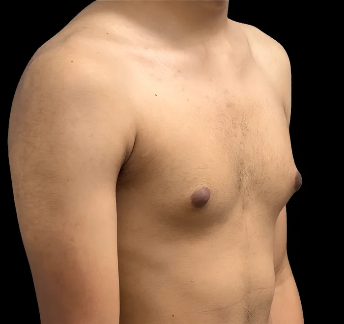 Gynaecomastia before, GYNO-005
