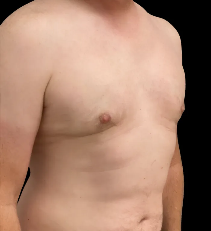Gynaecomastia after, GYNO-006