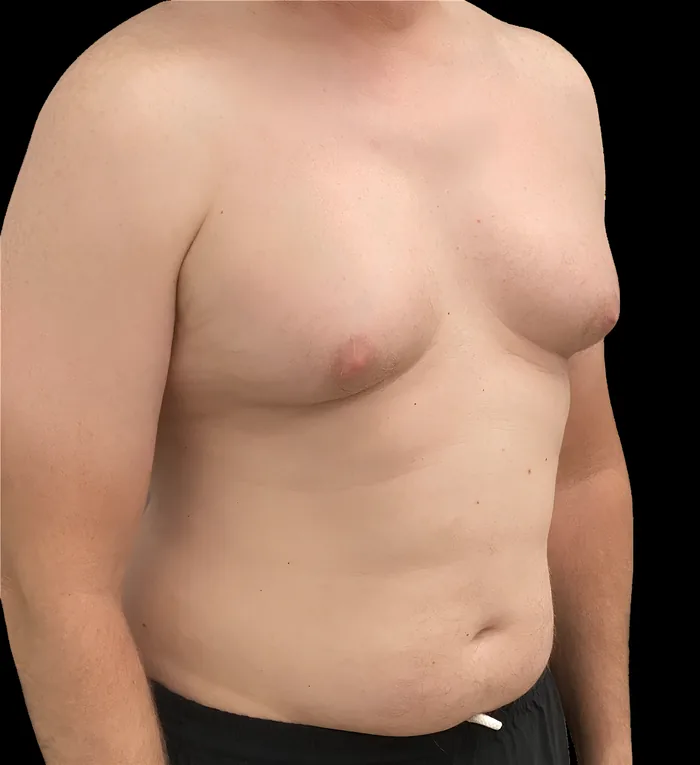 Gynaecomastia before, GYNO-006