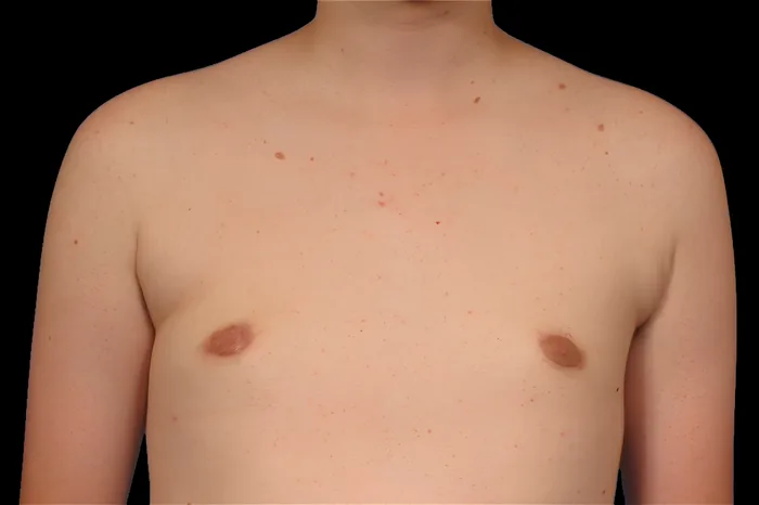 Gynaecomastia after, GYNO-007