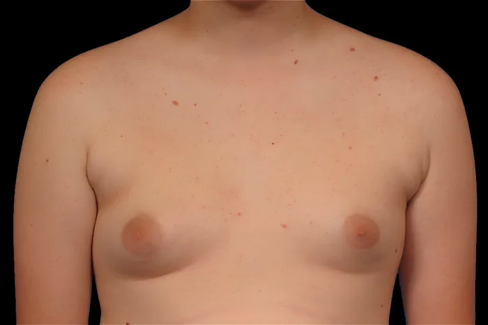 Gynaecomastia before, GYNO-007